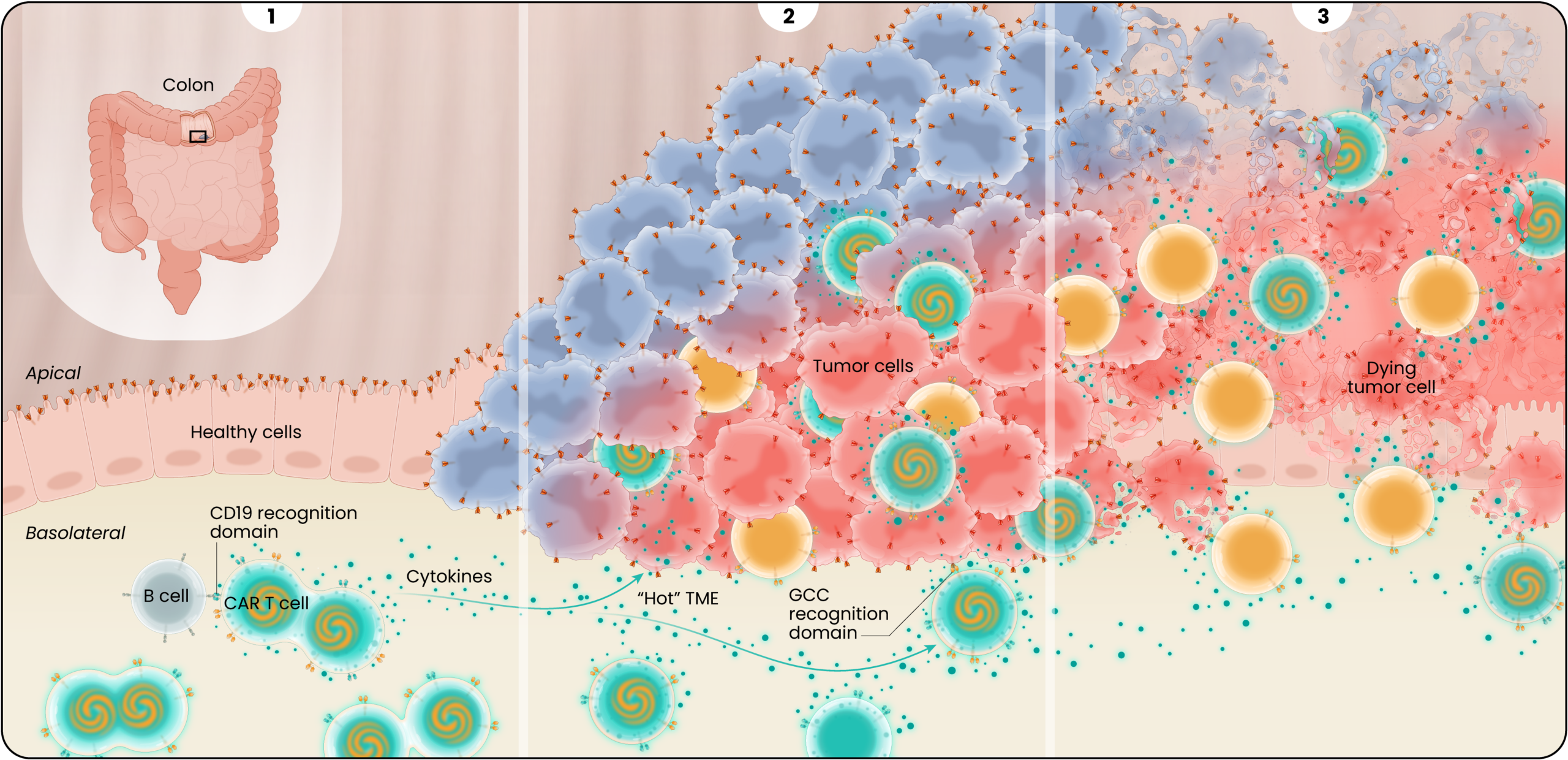 3-panel illustration of the proposed mechanism of action of LYL273 CAR T cells against colorectal cancer. Panel 1 contains an inset of the tumor location in the transverse colon and a cross-section of the colon’s cellular environment. The CAR T cells recognize the CD19 receptor on B cells on the basolateral side of the colon. The CAR T cells actively replicate, and begin releasing cytokines. Panel 2 shows the activated guanylyl cyclase-C (GCC)/CD19 doublet and GCC CAR T cells infiltrating the tumor where they bind to overexpressed GCC receptors on the tumor cells. The CAR T cells continue releasing cytokines to turn the immunologically cold tumor “hot.” Panel 3 shows the CAR T cells continuing to infiltrate the tumor and killing the tumor cells while leaving healthy cells untouched.